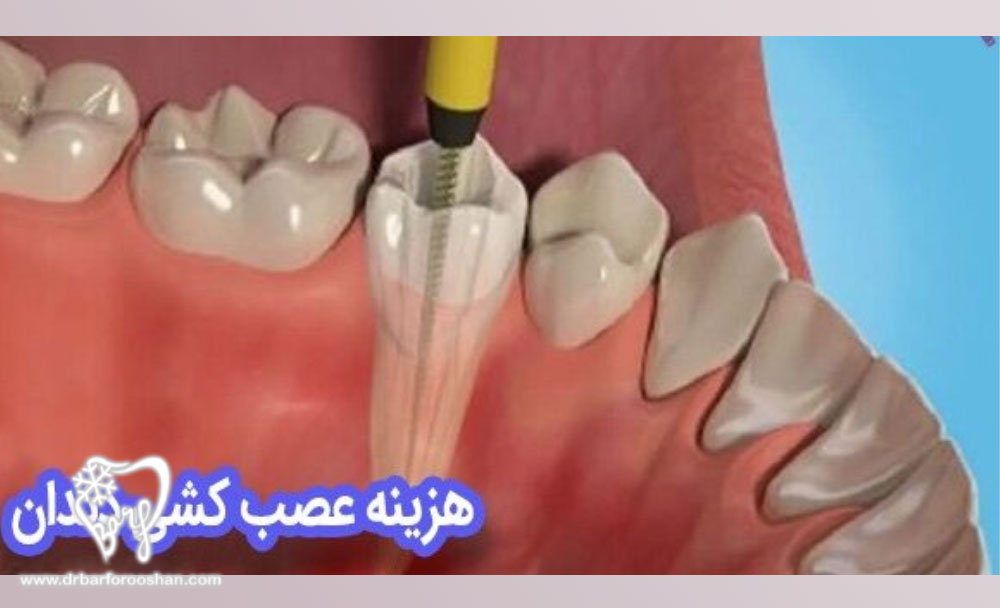 هزینه عصب کشی دندان