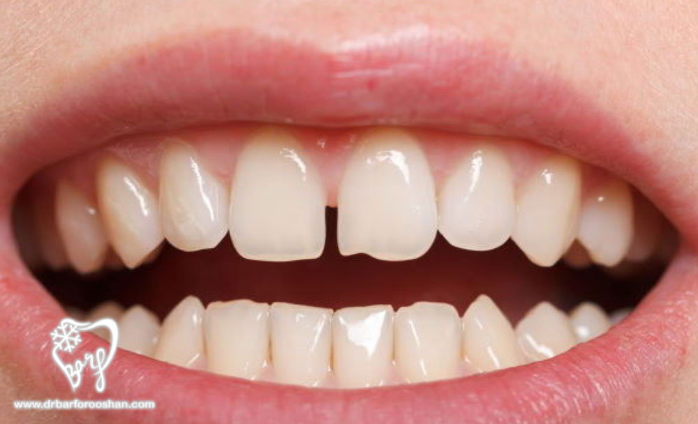فاصله دندانی یا دیاسما (Diastema)