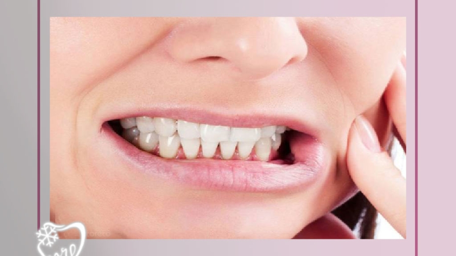 دندانقروچه چیست؟