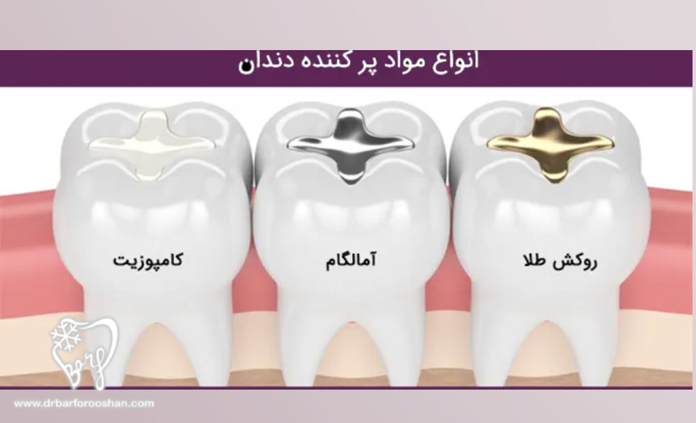 انواع پرکنندههای دندان