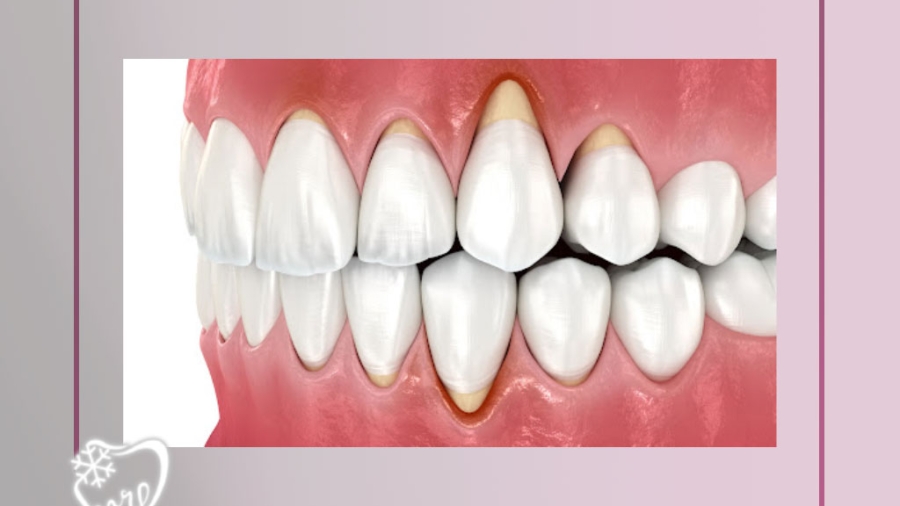 تحلیل لثه چیست؟