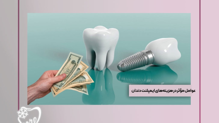 عوامل مؤثر در هزینه ایمپلنت دندان