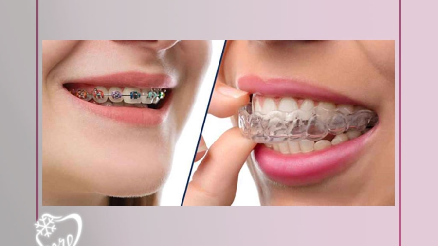 تفاوت ارتودنسی ثابت و متحرک