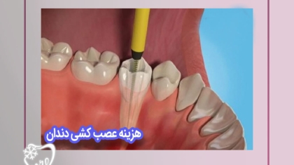 عوامل تاثیرگذار بر هزینه‌های عصب‌کشی دندان
