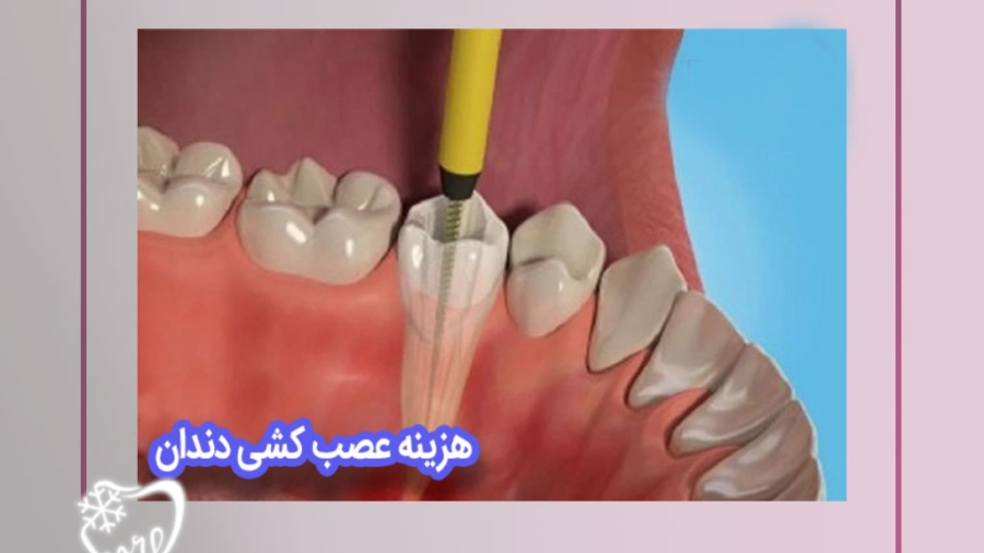 عوامل تاثیرگذار بر هزینه‌های عصب‌کشی دندان