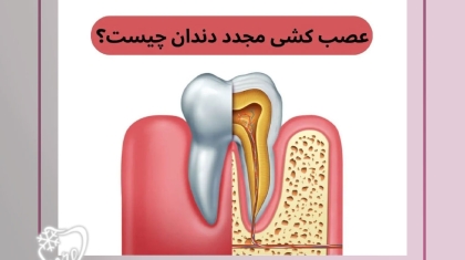 عصب‌کشی مجدد دندان