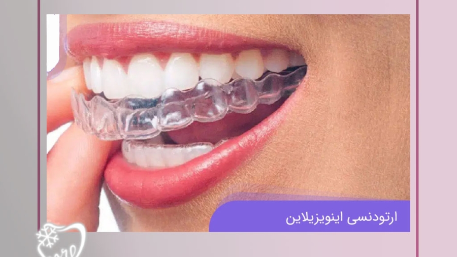  اینویزیلاین چیست؟