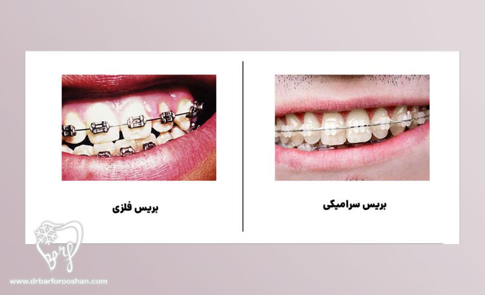 انتخاب بین ارتودنسی فلزی و سرامیکی