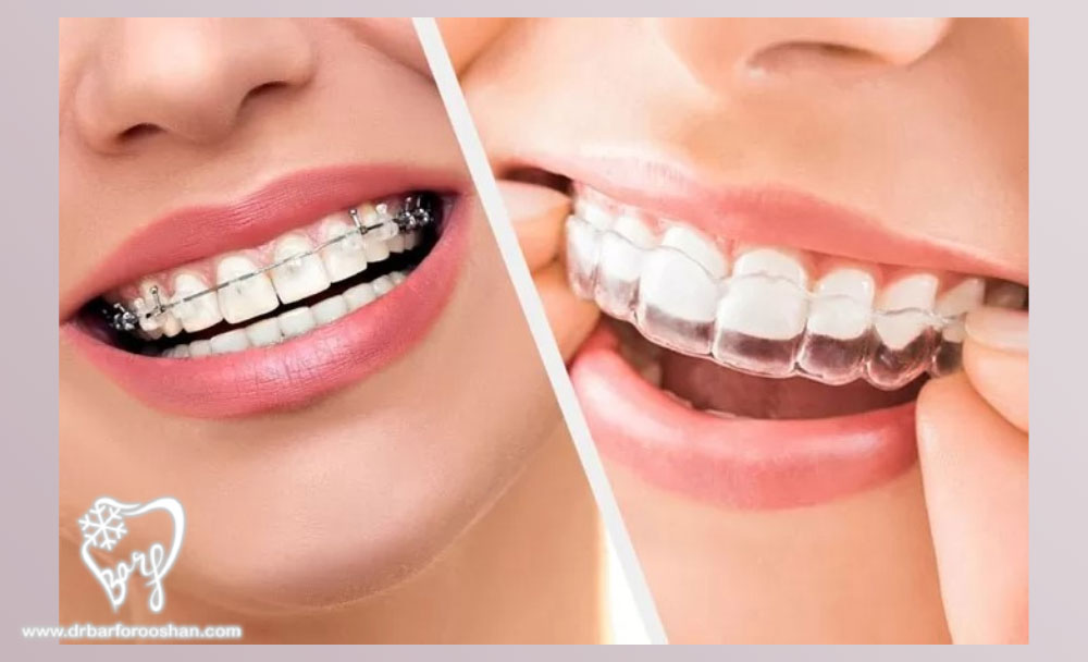 انواع ارتودنسی برای اصلاح طرح لبخند