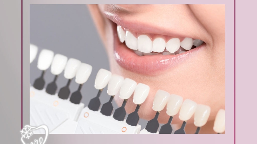 کامپوزیت ونیر چیست و چه مزایایی دارد؟