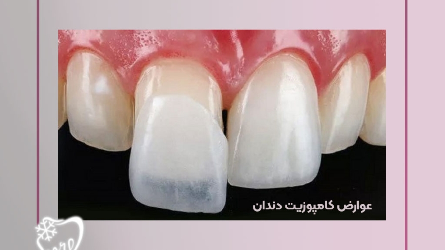 عوارض کامپوزیت