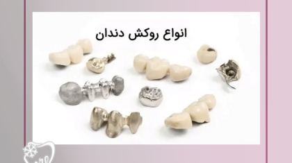 انواع جنس روکش دندان