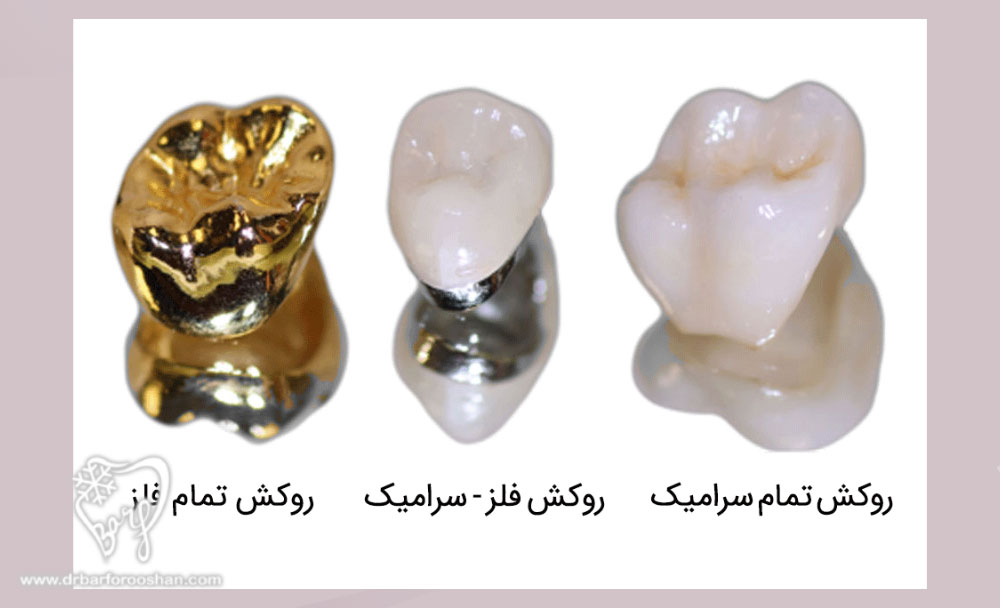 آشنایی با انواع جنس روکش دندان