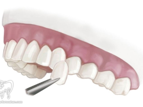 نحوه تعویض روکش دندان