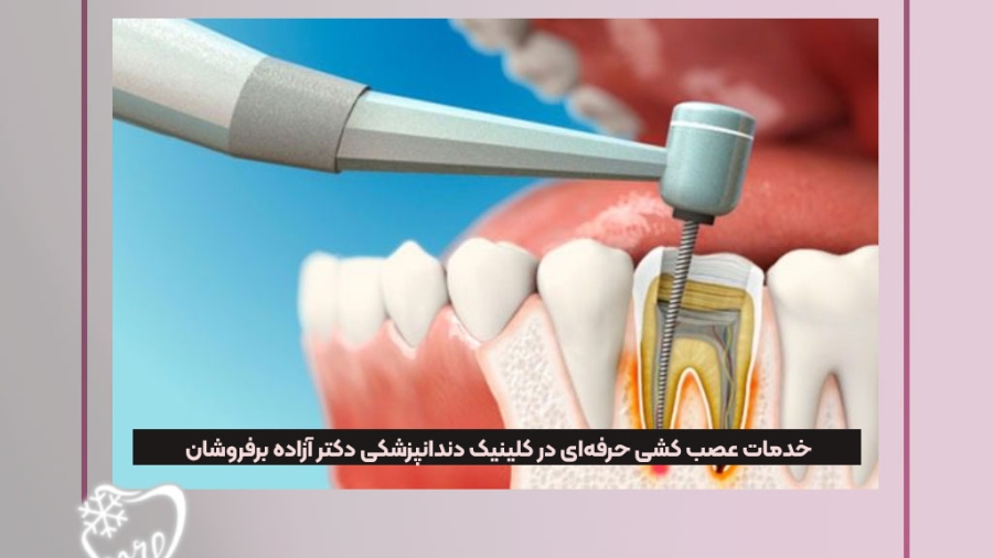 خدمات عصب کشی حرفهای