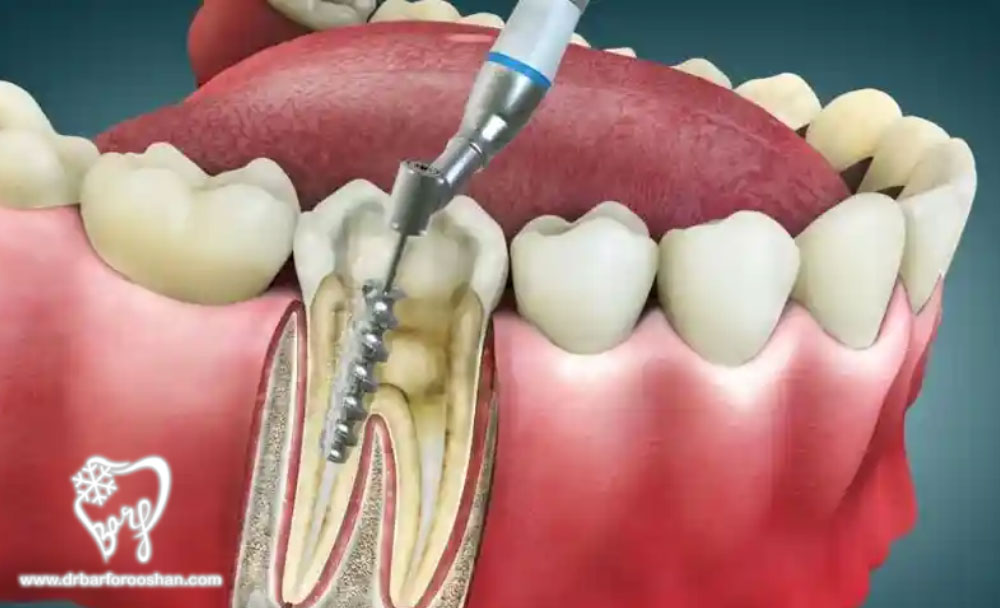 اهمیت خدمات عصب کشی حرفهای