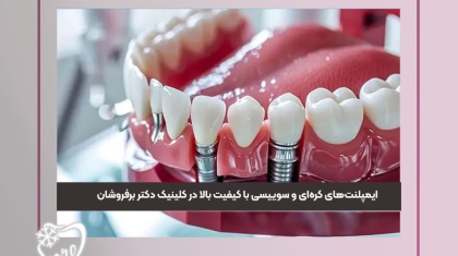 ایمپلنتهای کرهای و سوییسی
