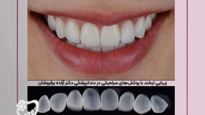 روکشهای سرامیکی