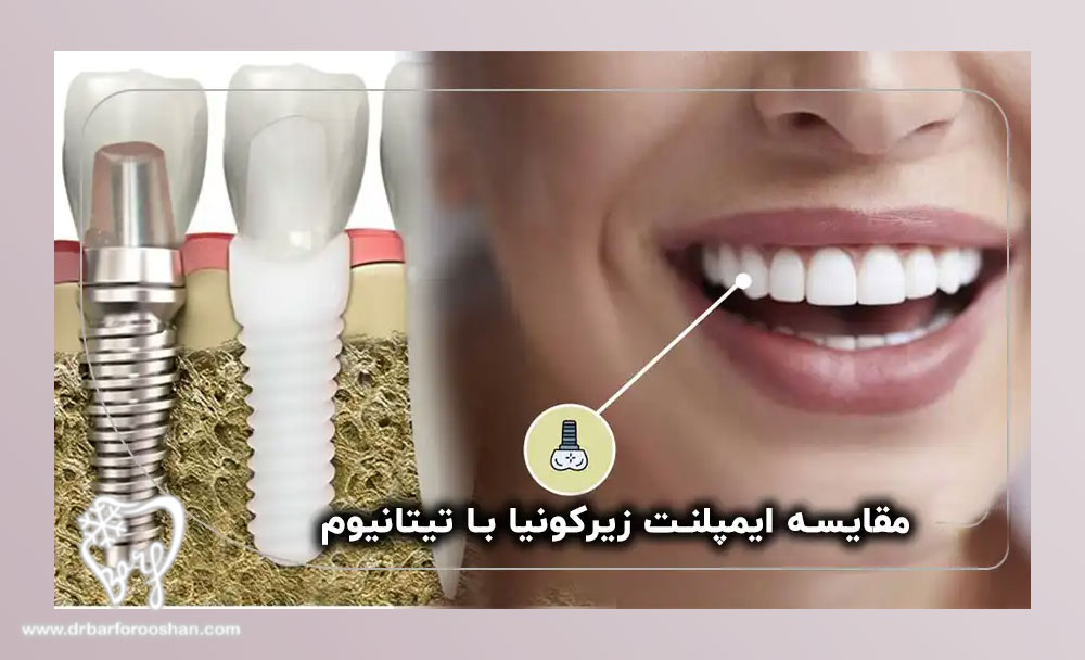 مقایسه ایمپلنت زیرکونیا و تیتانیوم