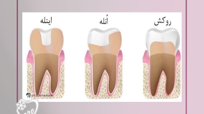 اینله و انله دندان