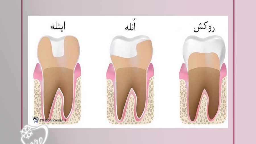 اینله و انله دندان