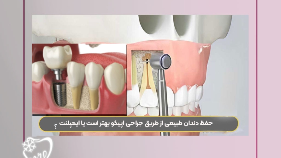 حفظ دندان طبیعی از طریق جراحی اپیکو