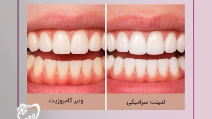 لمینت سرامیکی و ونیر کامپوزیت